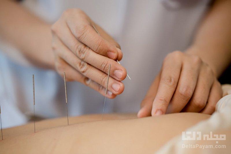 طب سوزنی چیست و چه فوایدی برای بدن دارد؟